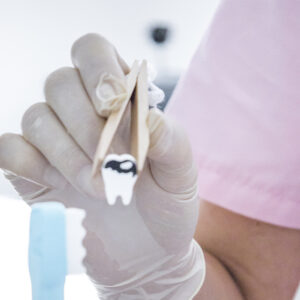 sl kazu Liečba zubného kazu