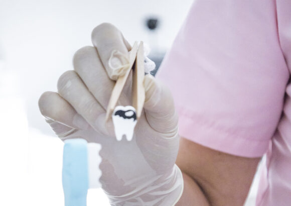 sl kazu Liečba zubného kazu